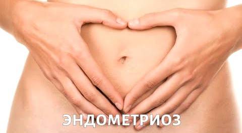 Эндометриоз: симптомы и лечение