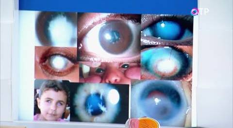 Помутнение роговицы глаза: современная медицина легко может устранить эту проблему