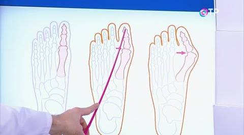 Вальгусная деформация большого пальца стопы: как не пропустить патологию на начальном этапе