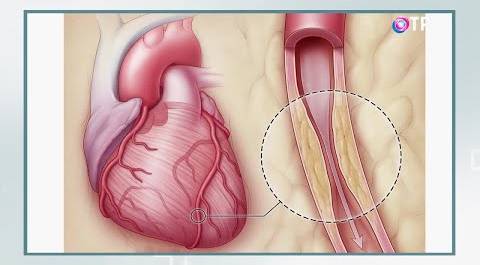 Ишемическая болезнь сердца: современные методы лечения