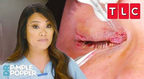 Growths in the WORST Places | Dr. Pimple Popper | TLC