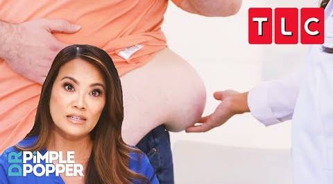 Large Lump Discovered After 300-Pound Weight Loss! | Dr. Pimple Popper | TLC