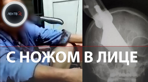 Выжила с ножом в лице | В Краснодарском крае врачи извлекли из носовой перегородки пациентки шеф-нож